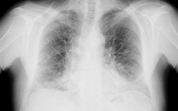 Plicní lékaři odhalili v Ústeckém kraji 4 nemocné. Den otevřených ambulancí upozornil na smrtelnou nemoc 